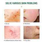 Acne Cream Treatment (1)