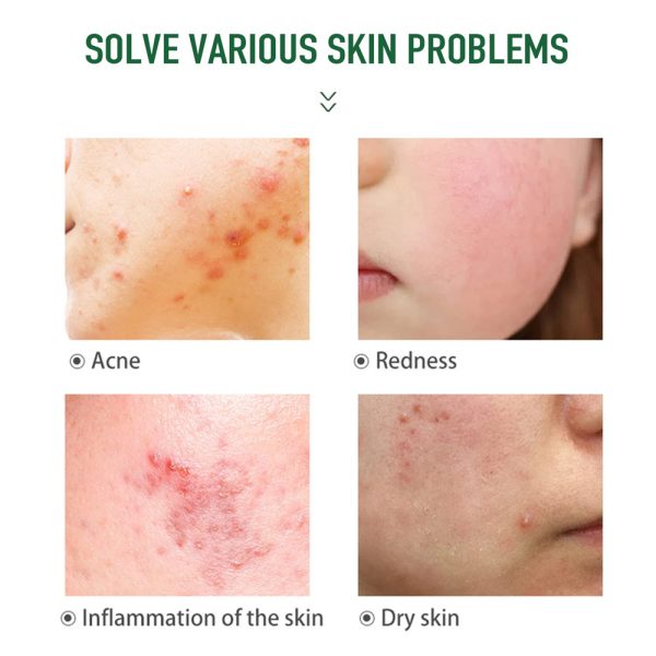 Skin Care Acne Cream Supplier, Contract Manufacturer