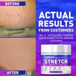 Stretch Mark Cream (5)